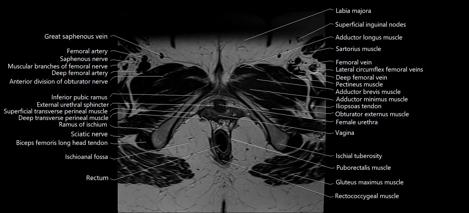 Axial cross sectional anatomy of female pelvis (MRI 3T) image 40.webp